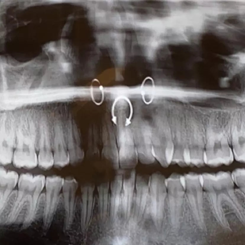 Piercings, Retainers, and Surgery